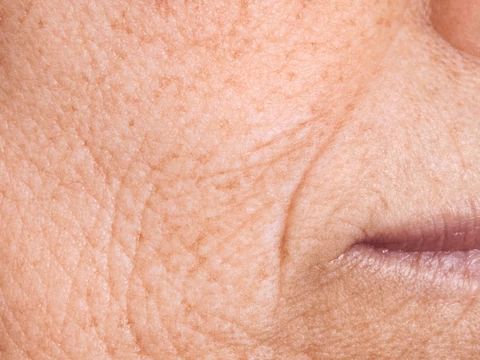 A ráncosodás okai és kezelése